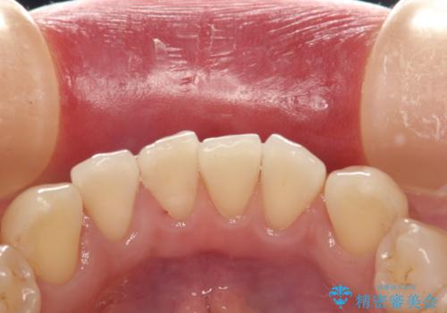 前歯の着色をPMTCできれいに除去の治療後