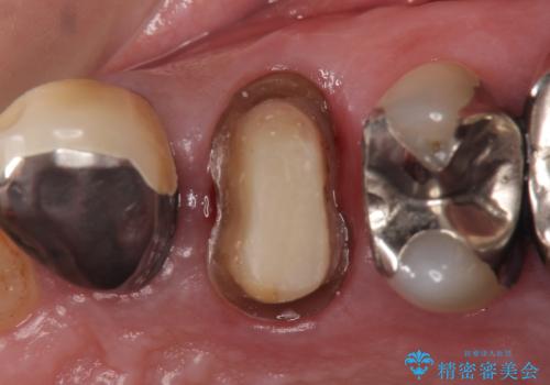 PGA(ゴールド)クラウン 脱離した銀歯の治療の治療中