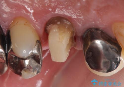 PGA(ゴールド)クラウン 脱離した銀歯の治療の治療中