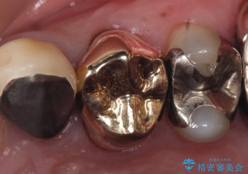 PGA(ゴールド)クラウン 脱離した銀歯の治療の症例 治療後