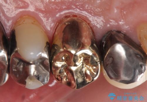 PGA(ゴールド)クラウン 脱離した銀歯の治療の治療後