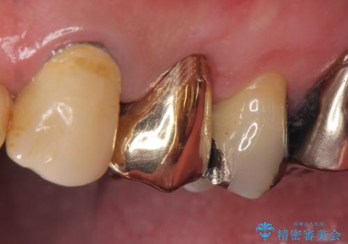 PGA(ゴールド)クラウン 脱離した銀歯の治療の治療後