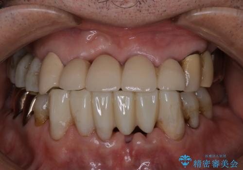 PMTCで被せもののケアの治療前