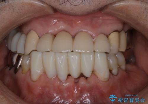 PMTCで被せもののケアの治療後