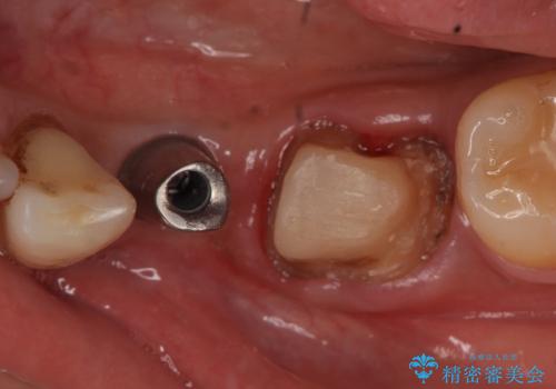 インプラント 左下奥歯の咬み合わせの改善の治療中
