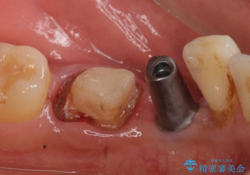 インプラント　左下奥歯の咬み合わせの改善の治療中