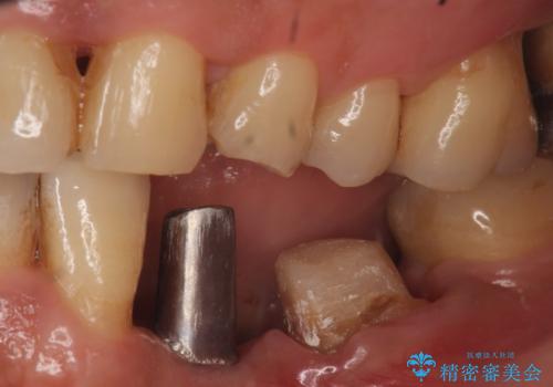 インプラント 左下奥歯の咬み合わせの改善の治療中