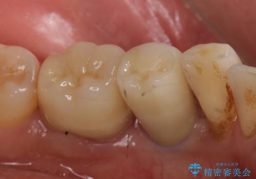 インプラント 左下奥歯の咬み合わせの改善の治療後