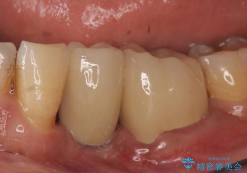 インプラント 左下奥歯の咬み合わせの改善の治療後