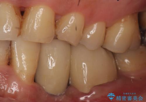 インプラント 左下奥歯の咬み合わせの改善の治療後