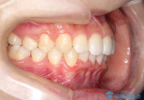 重度のガタガタのインビザラインによる非抜歯矯正の治療後