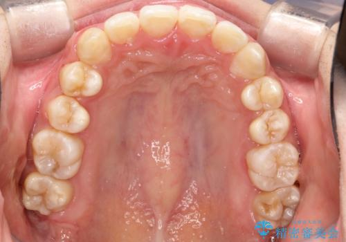 重度のガタガタのインビザラインによる非抜歯矯正の治療後