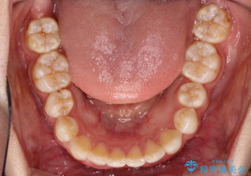 重度のガタガタのインビザラインによる非抜歯矯正の治療後