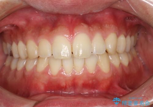 歯科検診と歯のお掃除の治療前