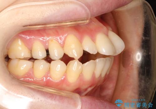 ワイヤーによる出っ歯の矯正　前歯でかめるようにの症例 治療前