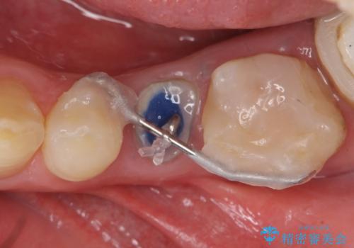 オールセラミッククラウン 歯の挺出・歯周外科による歯茎より深い虫歯の治療の治療中