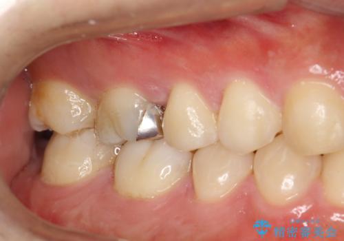 歯科検診と歯のお掃除の治療前