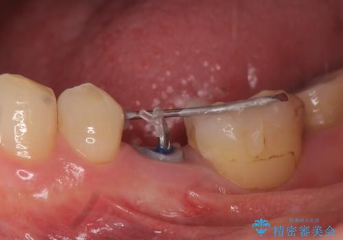 オールセラミッククラウン 歯の挺出・歯周外科による歯茎より深い虫歯の治療の治療中