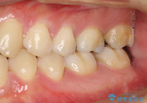 歯科検診と歯のお掃除の治療前