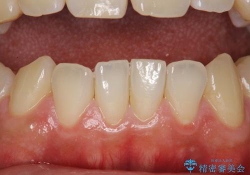 歯科検診と歯のお掃除の治療前