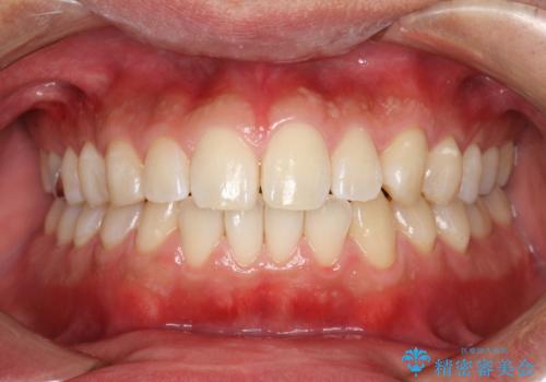 歯科検診と歯のお掃除の治療後