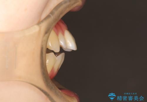 ワイヤーによる出っ歯の矯正 前歯でかめるようにの治療前