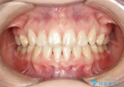 歯が前に出てて、口が閉じない 抜歯矯正による口元の改善の治療後