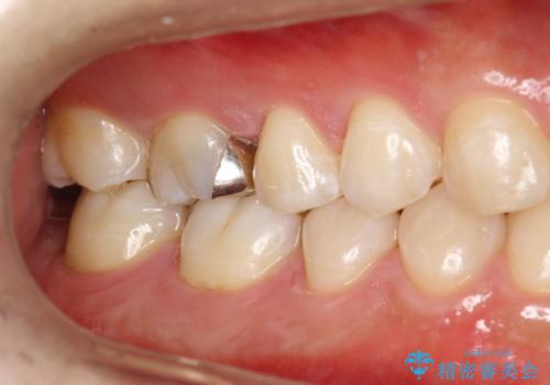 歯科検診と歯のお掃除の治療後