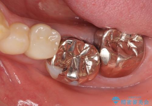 オールセラミッククラウン 歯の挺出・歯周外科による歯茎より深い虫歯の治療の治療前