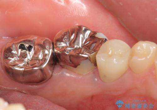 オールセラミッククラウン 歯の挺出・歯周外科による歯茎より深い虫歯の治療の治療前