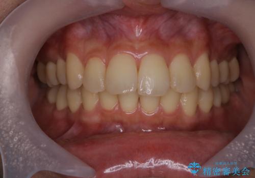 歯科衛生士による専門的なクリーニング　PMTCの治療前