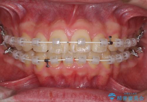 前歯のデコボコを短期間で治療 目立たないワイヤー矯正の治療中