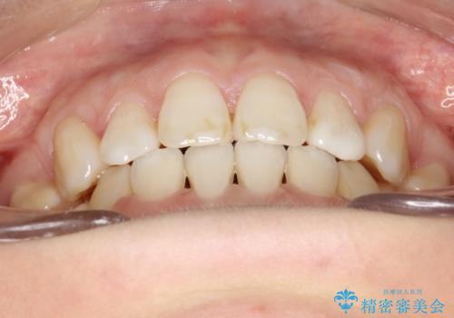 歯が前に出てて、口が閉じない 抜歯矯正による口元の改善の治療後