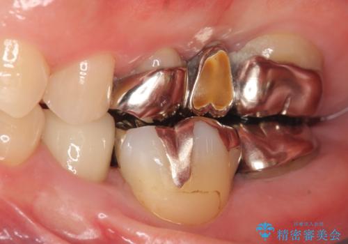 オールセラミッククラウン 歯の挺出・歯周外科による歯茎より深い虫歯の治療の治療前