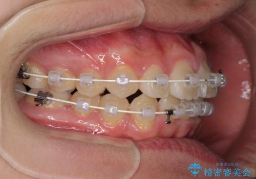 前歯のデコボコを短期間で治療　目立たないワイヤー矯正の治療中