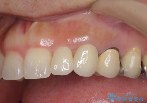 前歯が左右対称じゃない　保険の被せ物をきれいにしたい　ホワイトニング併用の治療後