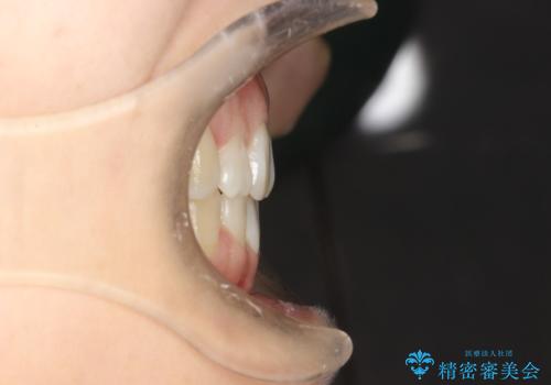 歯が前に出てて、口が閉じない 抜歯矯正による口元の改善の治療後