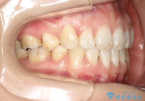 歯が前に出てて、口が閉じない　抜歯矯正による口元の改善の治療後