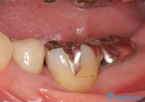 オールセラミッククラウン 歯の挺出・歯周外科による歯茎より深い虫歯の治療の症例 治療前