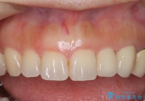 前歯が左右対称じゃない　保険の被せ物をきれいにしたい　ホワイトニング併用の症例 治療後