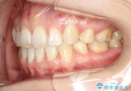 歯が前に出てて、口が閉じない 抜歯矯正による口元の改善の治療後