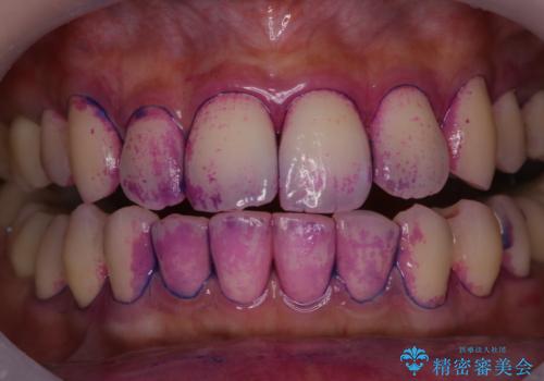 歯科衛生士による専門的なクリーニング PMTCの治療中