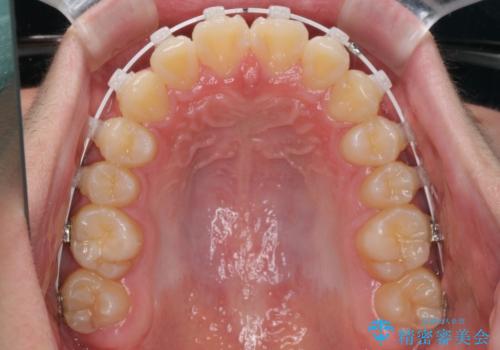 前歯のデコボコを短期間で治療 目立たないワイヤー矯正の治療中