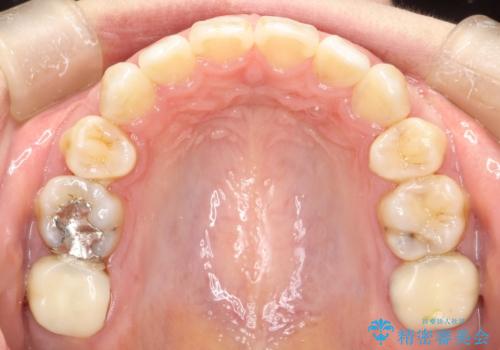 歯が前に出てて、口が閉じない 抜歯矯正による口元の改善の治療後
