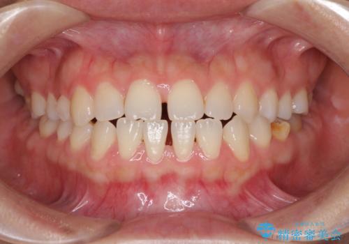 隙間の空いた前歯を治したい インビザライン矯正治療の治療前