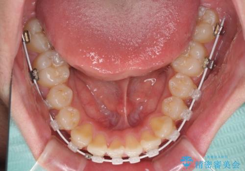 前歯のデコボコを短期間で治療 目立たないワイヤー矯正の治療中