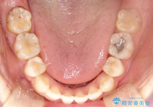 歯が前に出てて、口が閉じない 抜歯矯正による口元の改善の治療後