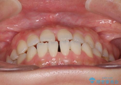 隙間の空いた前歯を治したい インビザライン矯正治療の治療前