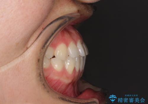 隙間の空いた前歯を治したい インビザライン矯正治療の治療前