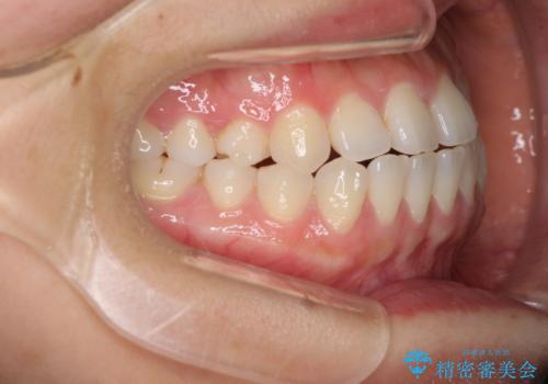 隙間の空いた前歯を治したい インビザライン矯正治療の治療前